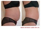 laser lipo inch loss