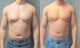 before and after gynecomastia